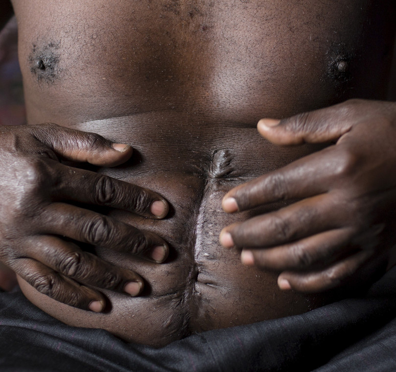A man shows scars from gunshot wounds sustained when he was attacked by a gang in Makadera in Nairobi, 27 April 2015.
